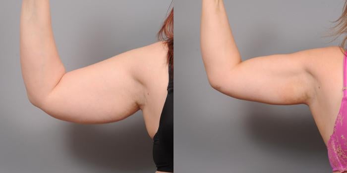 SlimaPlast™ | Lose up to 5kg – without dieting or hard exercise, in just a few days 13 1739785471 arm liposuction 159 view 1 thumbnail