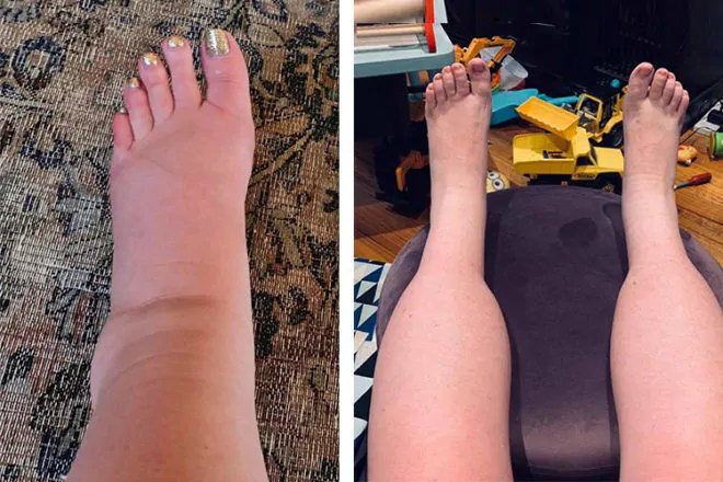 CalfCare 6 1733416145 Swelling in pregnancy FI