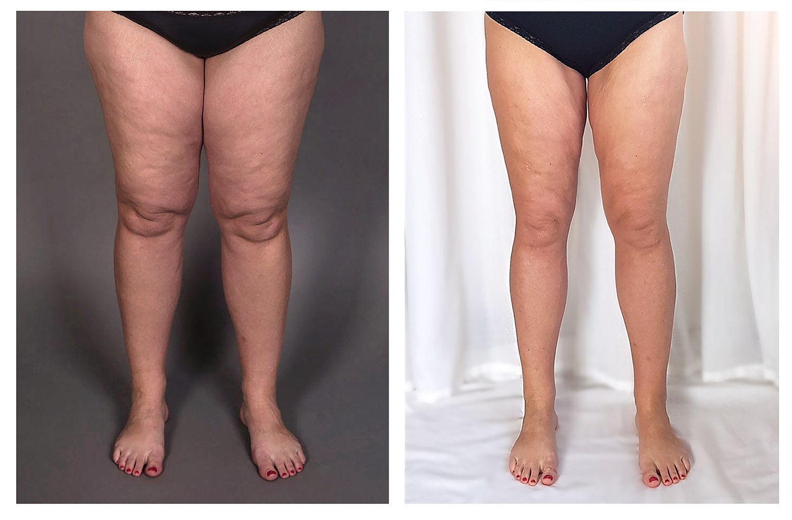 CalfCare 14 1733446830 lipedema swollen legs progressive physical therapy astym treatment orange county garden grove orange fountain valley