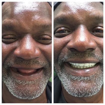 ComfortFit™ Dentures | Achieves a flawless smile, no discomfort 13 1742969155 large image 1555524363