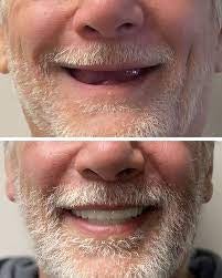 ComfortFit™ Dentures | Achieves a flawless smile, no discomfort 14 1742969159 images