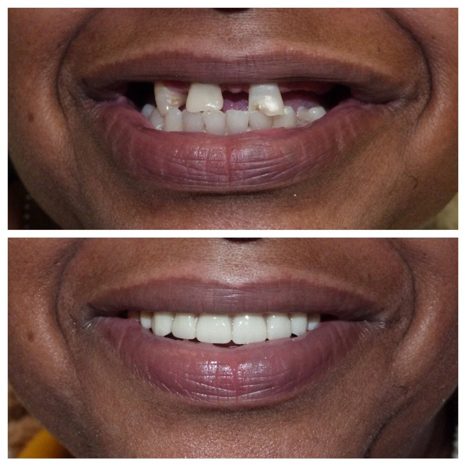 ComfortFit™ Dentures | Achieves a flawless smile, no discomfort 15 1742969233 148352