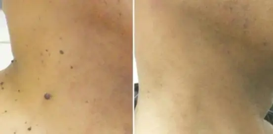 Wartax™ Wart Remover | Eliminate All Your Warts Painlessly 24 1744897730 1728603389 Schermopname%20%2866%29