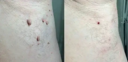 Wartax™ Wart Remover | Eliminate All Your Warts Painlessly 25 1744897734 1728603405 Schermopname%20%2867%29