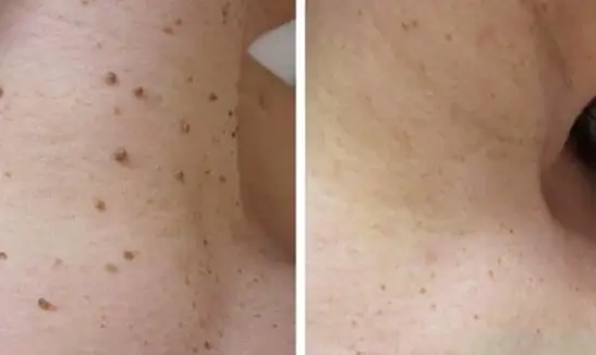 Wartax™ Wart Remover | Eliminate All Your Warts Painlessly 26 1744897737 1728603424 Schermopname%20%2868%29