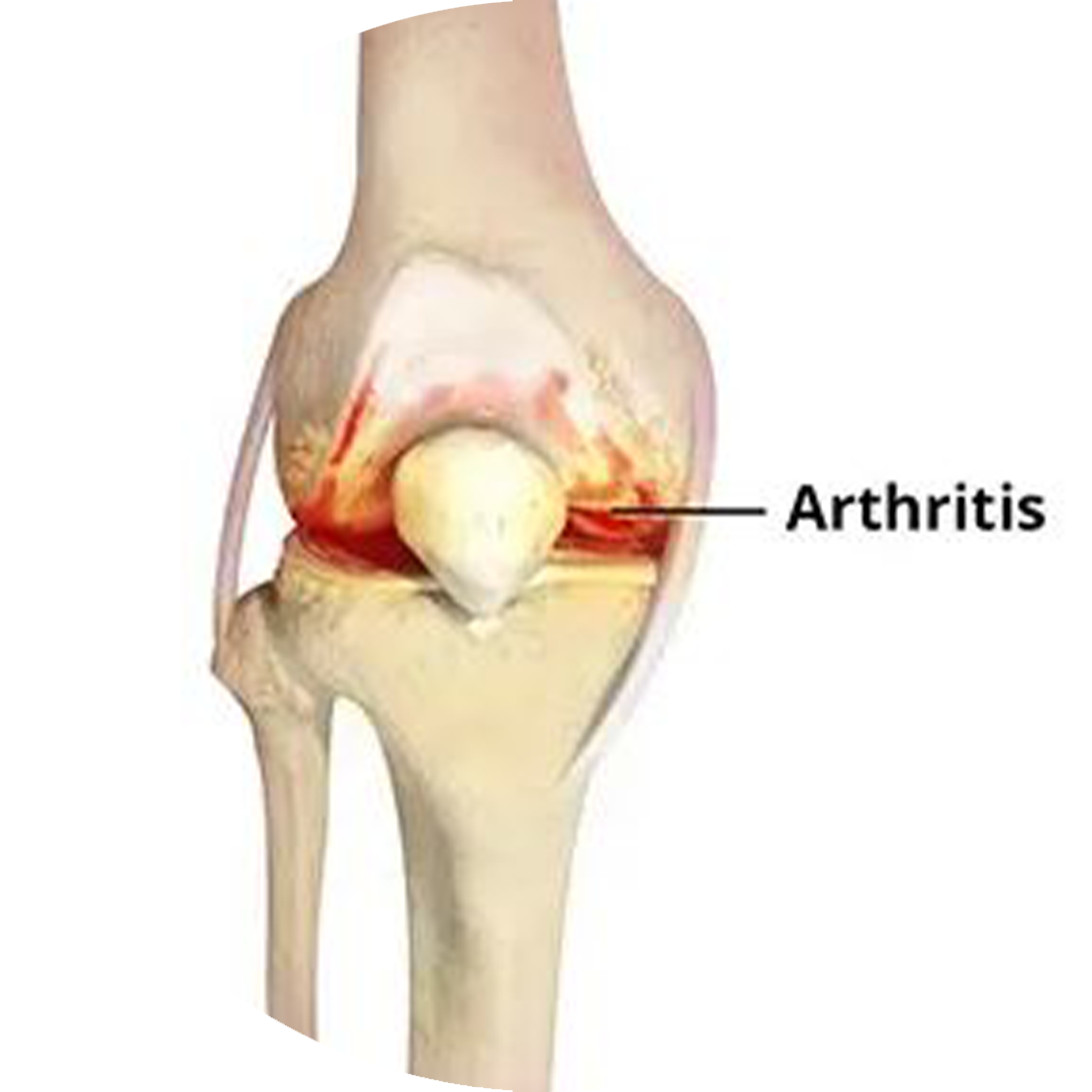 Arthrose du genou