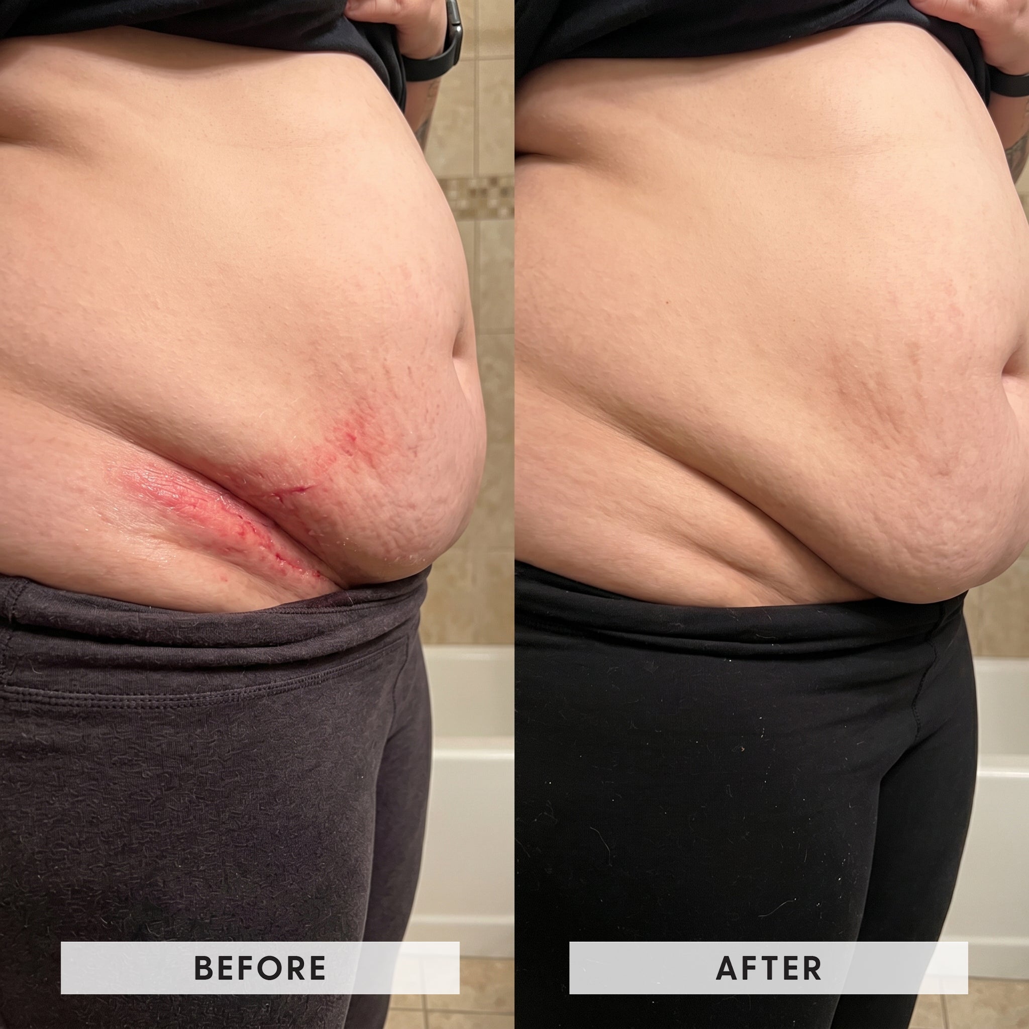 Waistline and belly fold rash transformation
