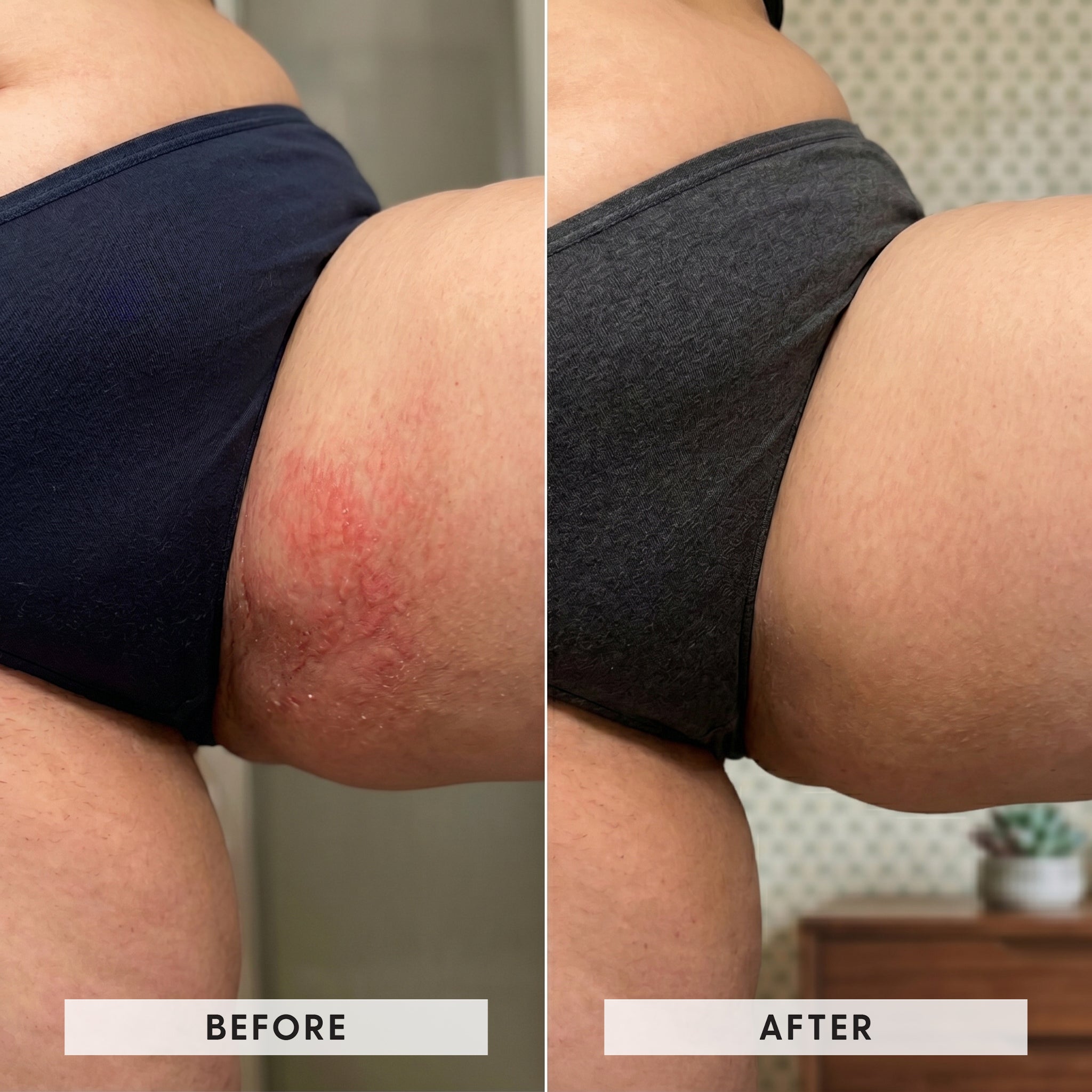 Groin and inner thigh rash transformation