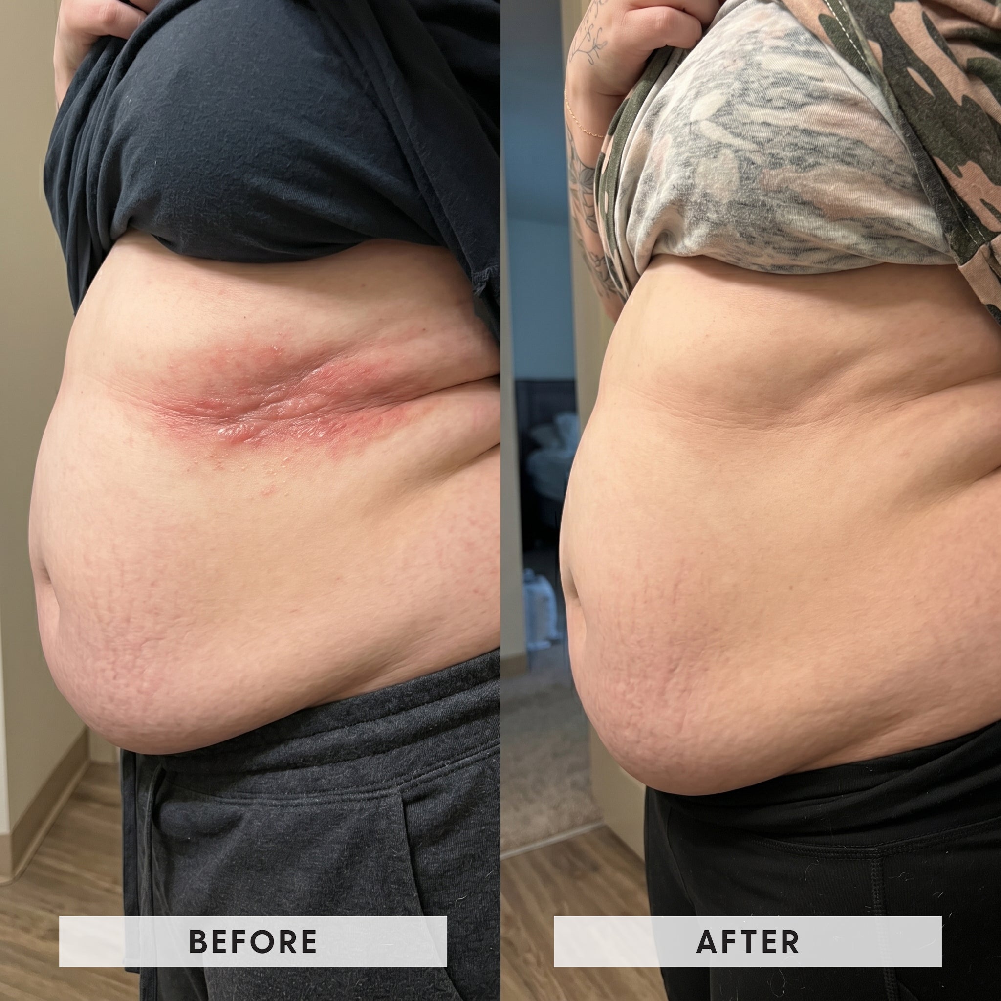 Waistline and belly fold rash transformation