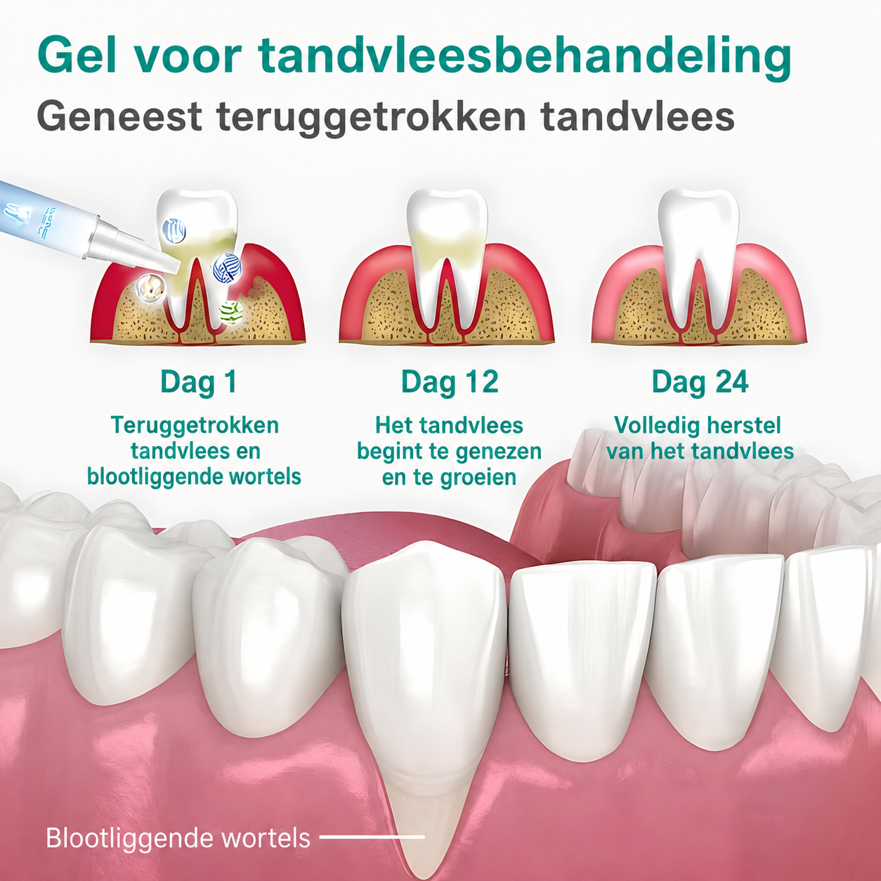 Gel voor tandvleesbehandeling