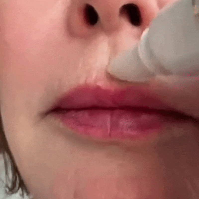 SnapLift Instant Line Filler result