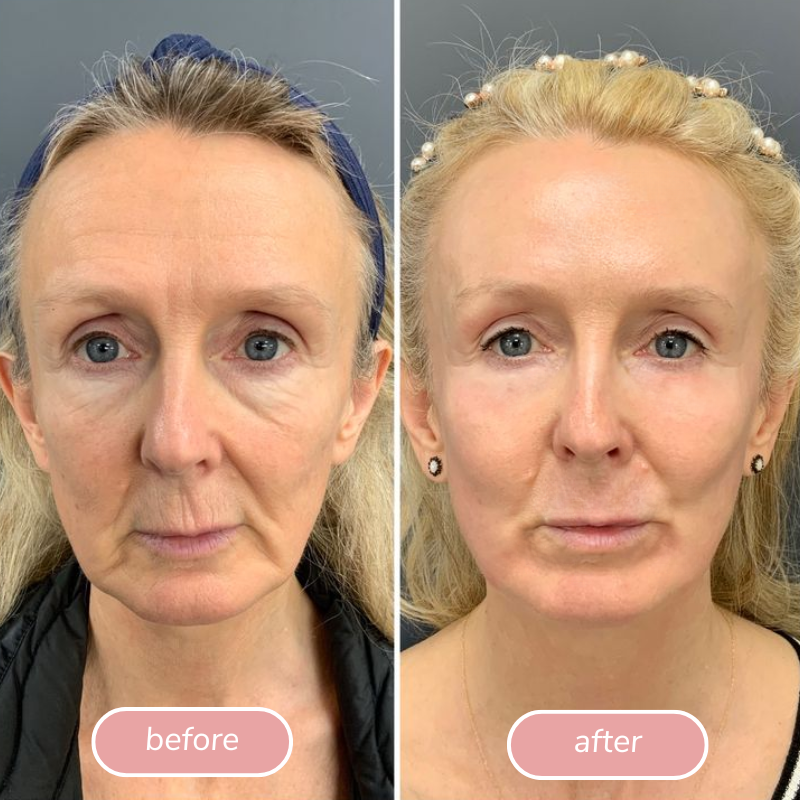 SnapLift firmer-looking mature skin