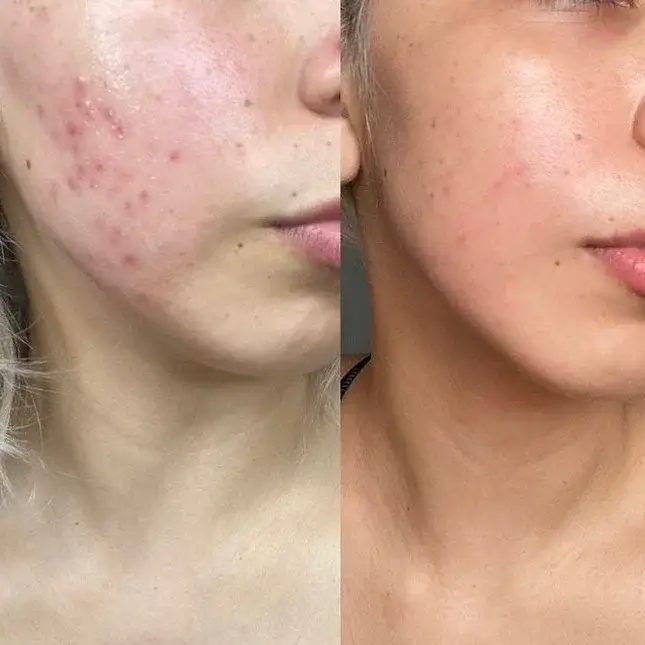 Antes y después poros/puntos negros