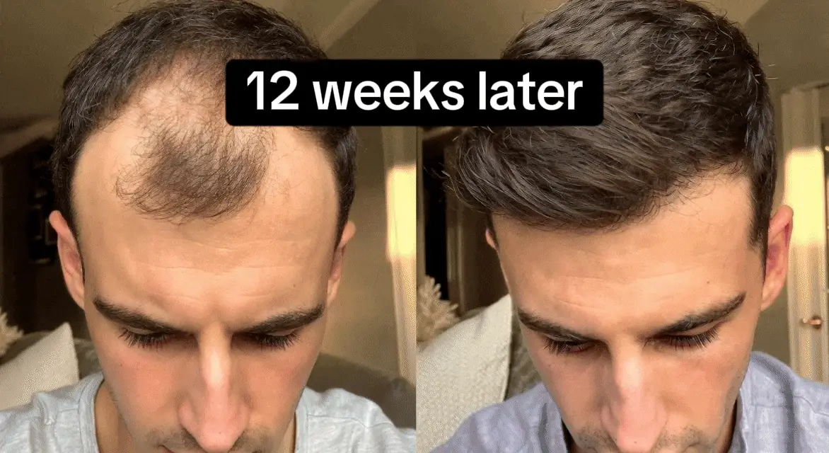 The NovaMane 3-step protocol: stamp, apply serum, done in 60 seconds