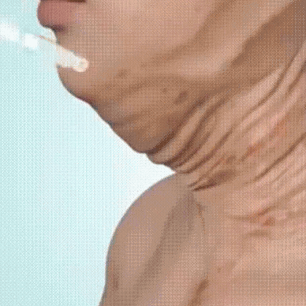 DermaLift™ Botox Soliton For Wrinkles Hyarulonic Acid