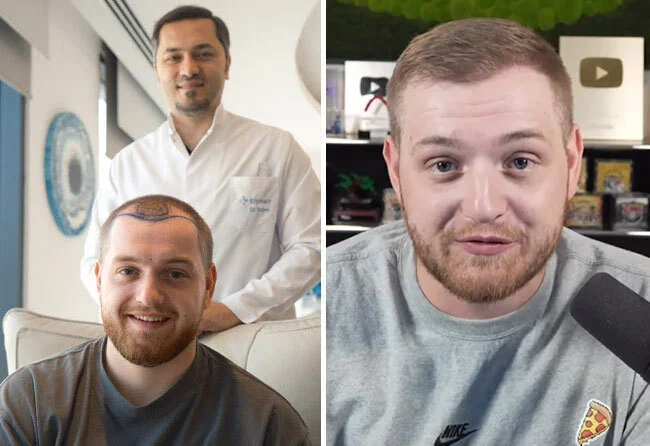 Vorher-Nachher DHI-Haartransplantation 3400 Grafts