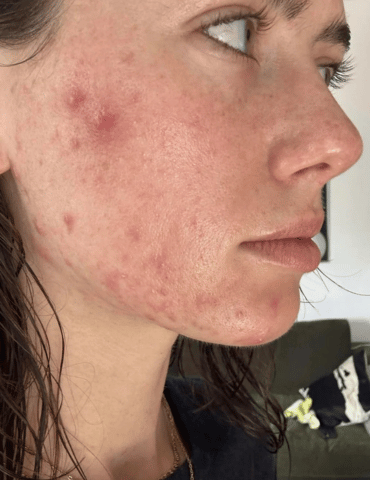 New Acne Treatment Study Native