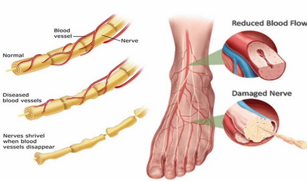 NeuropathyVanish™ Total Neuropathy Care 