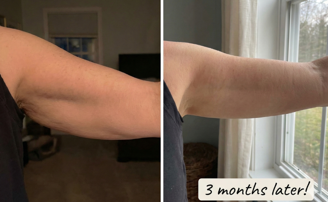 Before and after arm skin results from consistent Sonicfit use