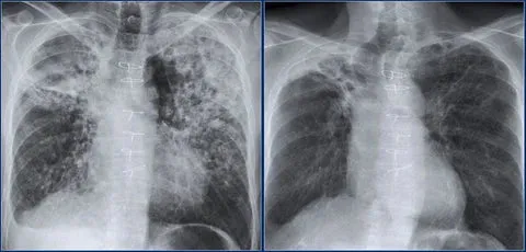 Lungs