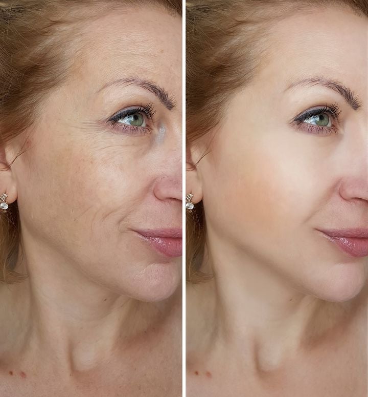 1729074813 stock photo face woman wrinkles before and after treatments 1057930082 720w