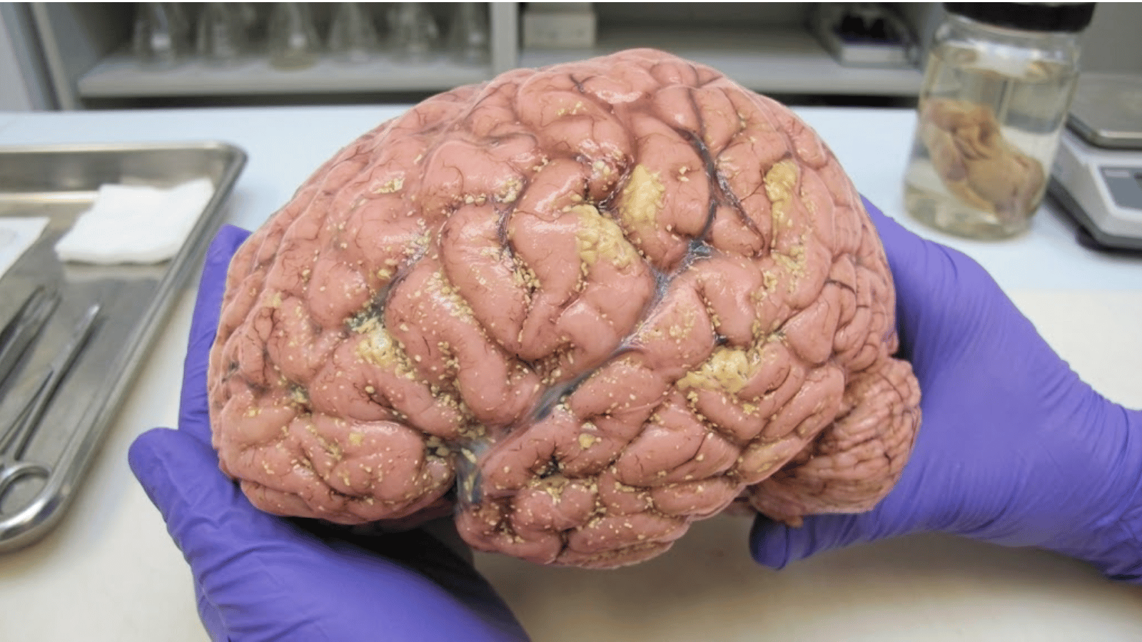 Anatomical diagram of the three brain regions affected by cognitive decline after 40