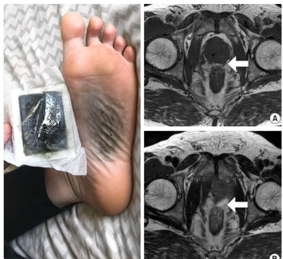 LOVILDS Prostate Patches