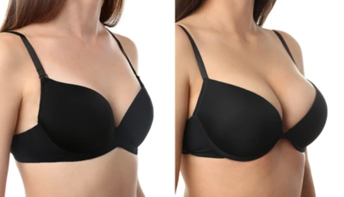 Before and after, side profile