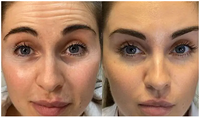 EMS™ Facelifting Rejuvenationkit Special Offer