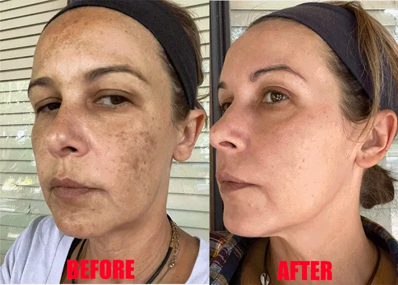 Dermaclear™ Probiotic Anti-Dark Spot Serum | Erases spots, marks and dull complexion in 3 minutes!