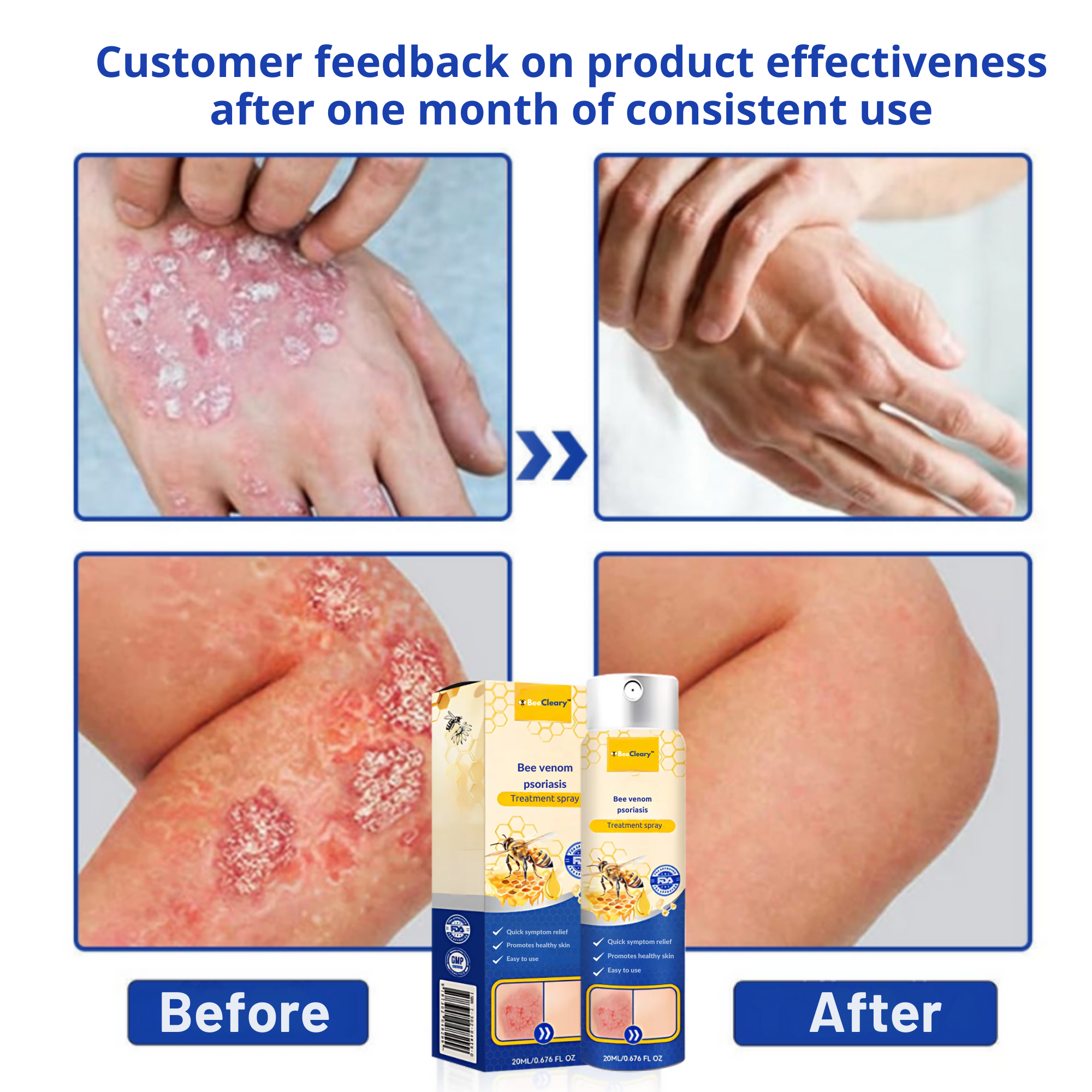 BeeCleary™ Spray | Permanently Remove Psoriasis & Eczema 23 1735735493 10