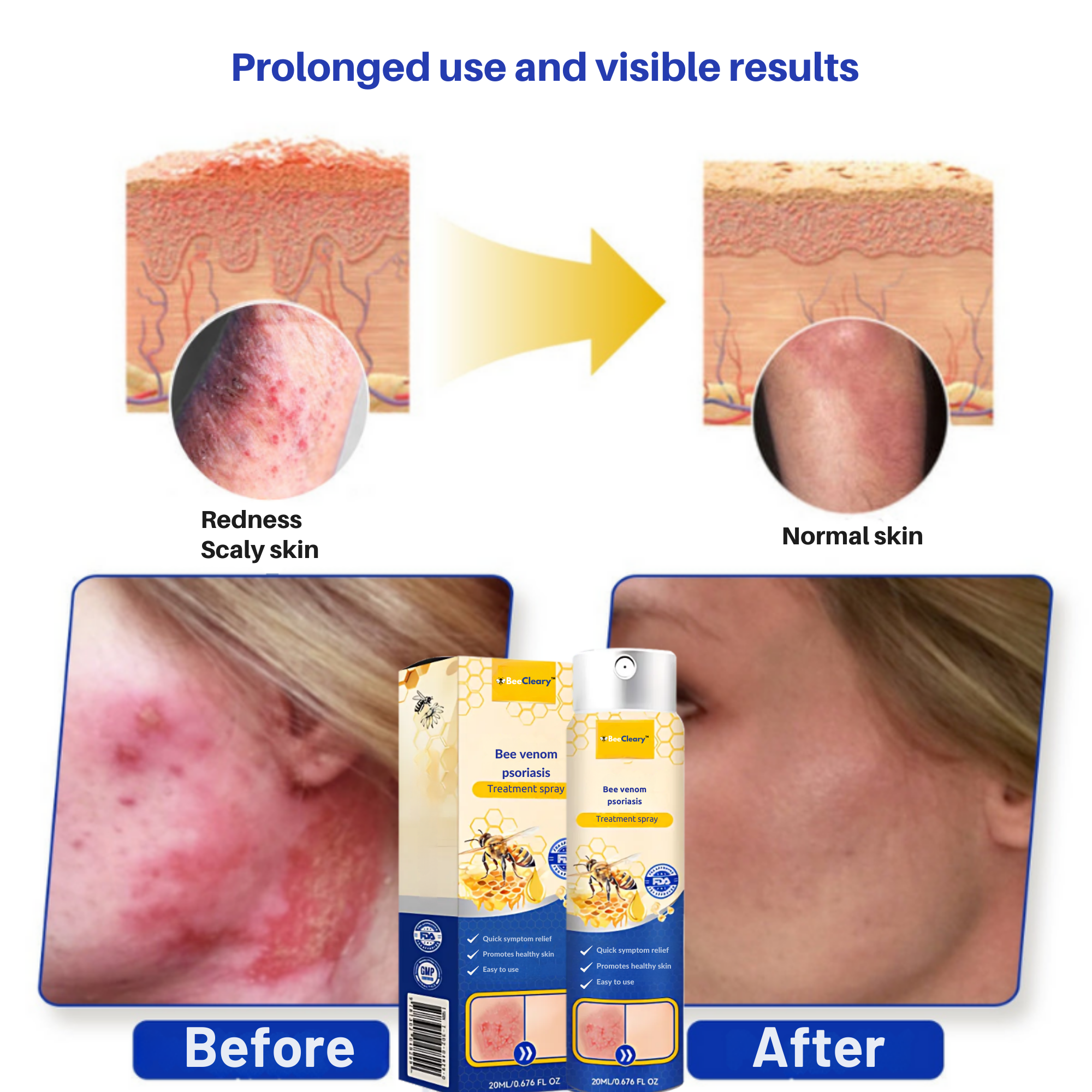 BeeCleary™ Spray | Permanently Remove Psoriasis & Eczema 22 1735735502 11