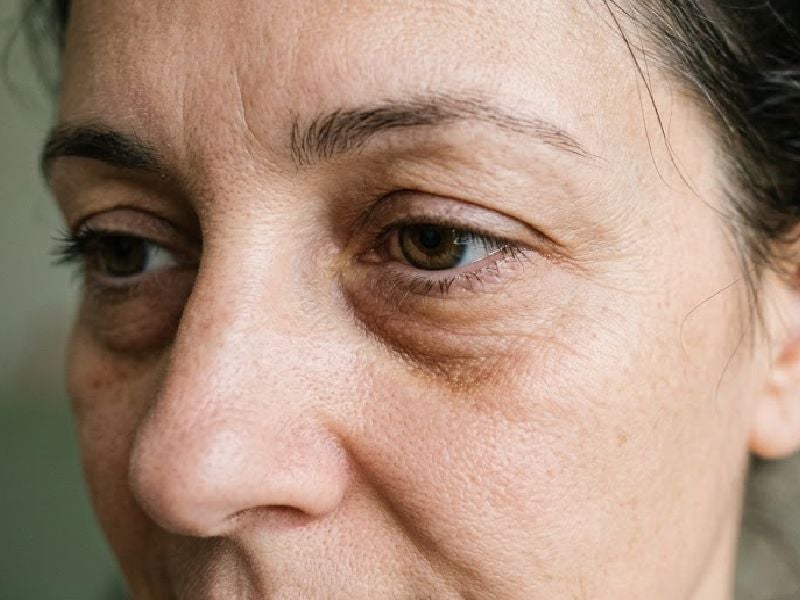 Close-up of an aging eye area