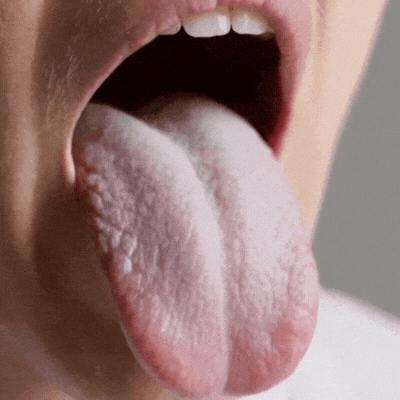 CandiClean™ Candida Cleanse-Clears WhiteTongue.