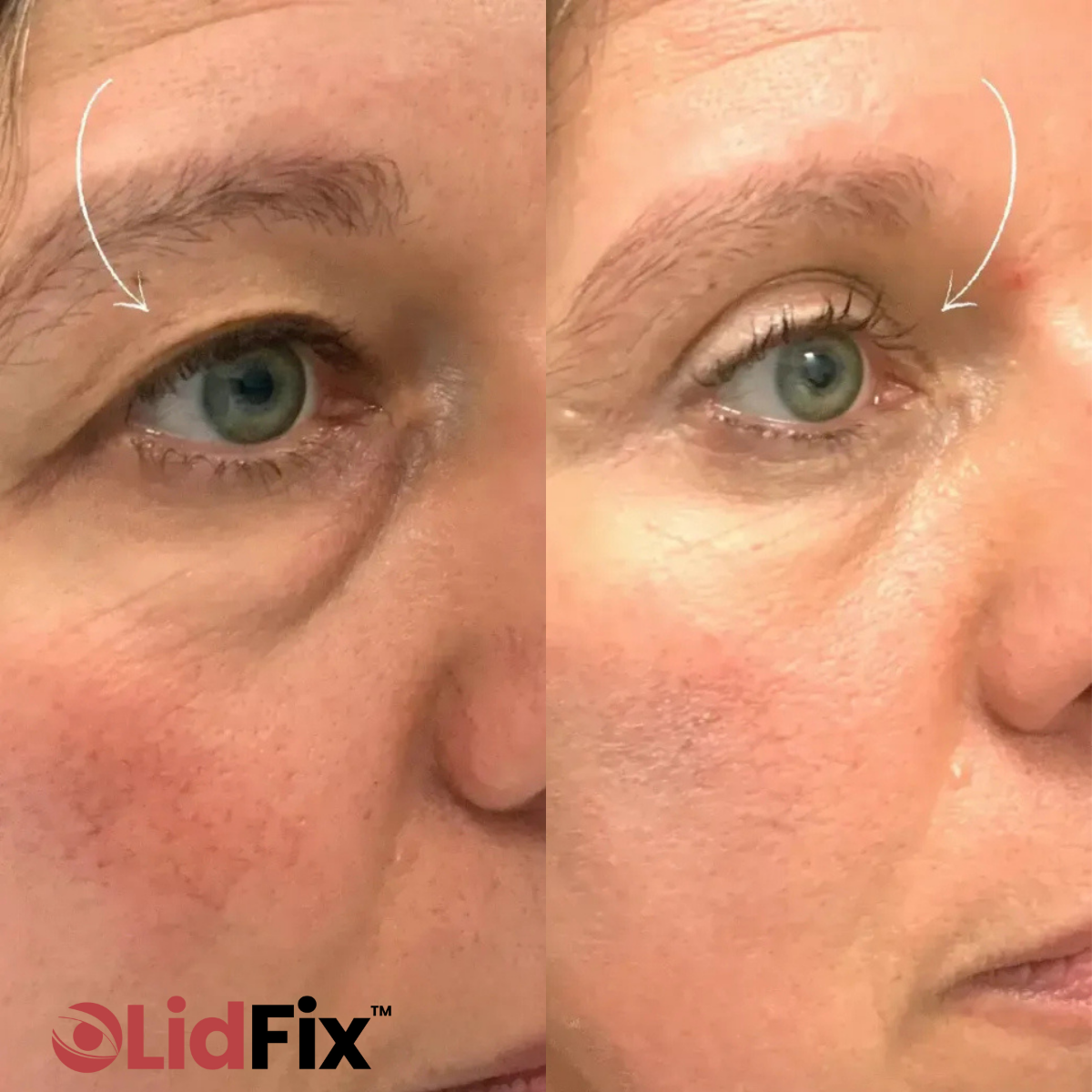 LidFix™ Eye Cream | Instantly lift your eyelids without Botox 14 1768277667