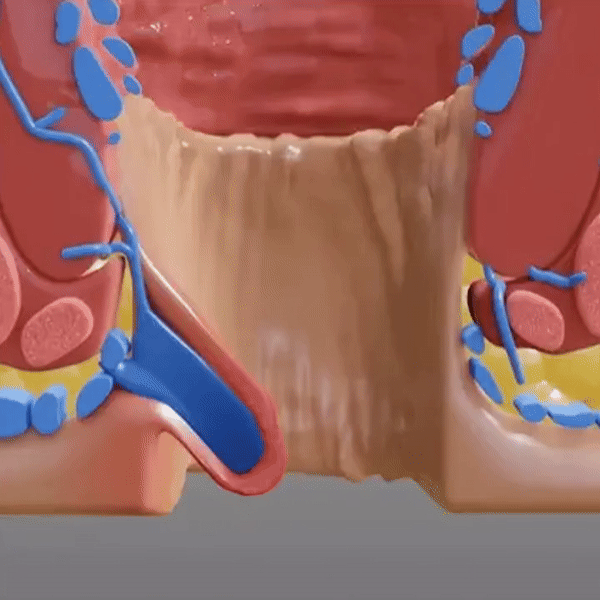 HemoLex™ | Natural Relief and Prevention for Haemorrhoids 21 HemoLex™ | Natural Relief and Prevention for Haemorrhoids