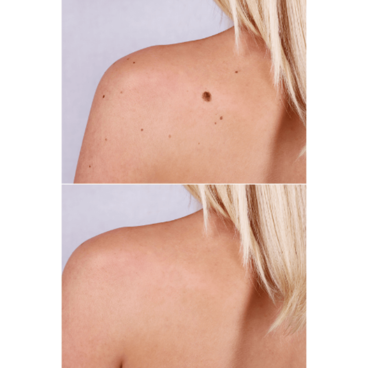 Wartax™ Wart Remover | Eliminate All Your Warts Painlessly 21 1744897331 7