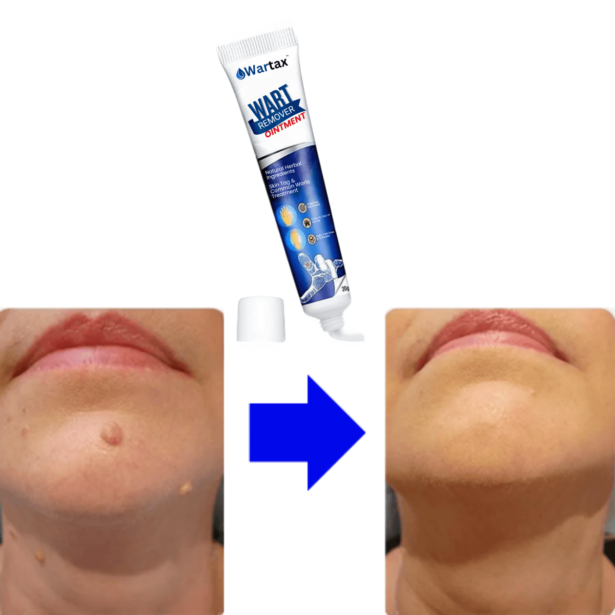 Wartax™ Wart Remover | Eliminate All Your Warts Painlessly 27 1744897346 uk%20%283%29