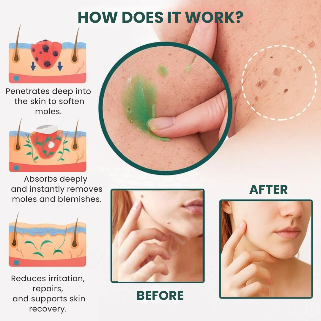 SilkSkin™ | Clinically Proven to Remove 97% of Moles, Warts & Blemishes – Permanently in Just 3 Days!