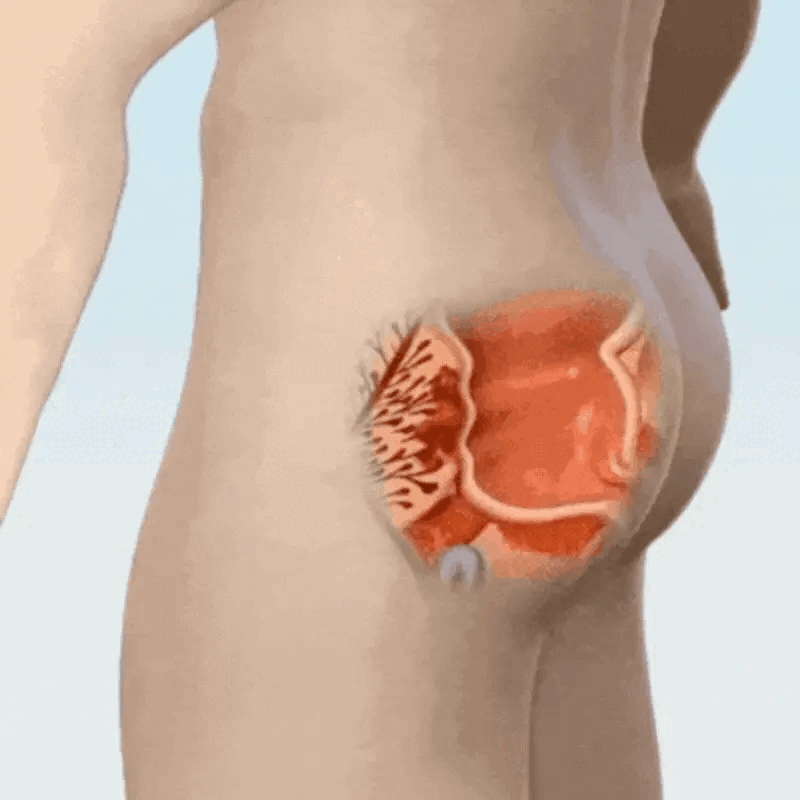 Prosixo™ Prostate Complex