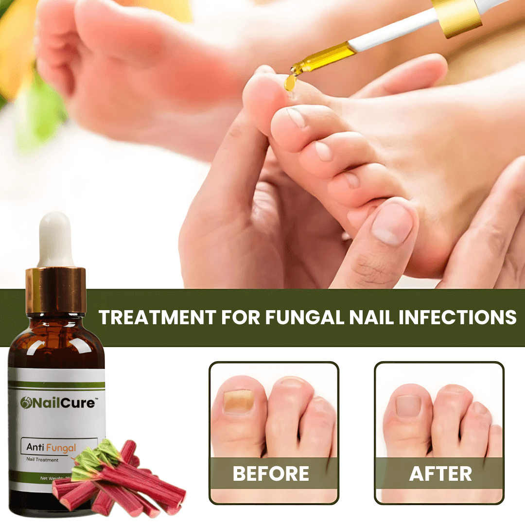 NailCure™ Fungal Nail Drops | Removes 90% of Nail Fungus in 7 Days