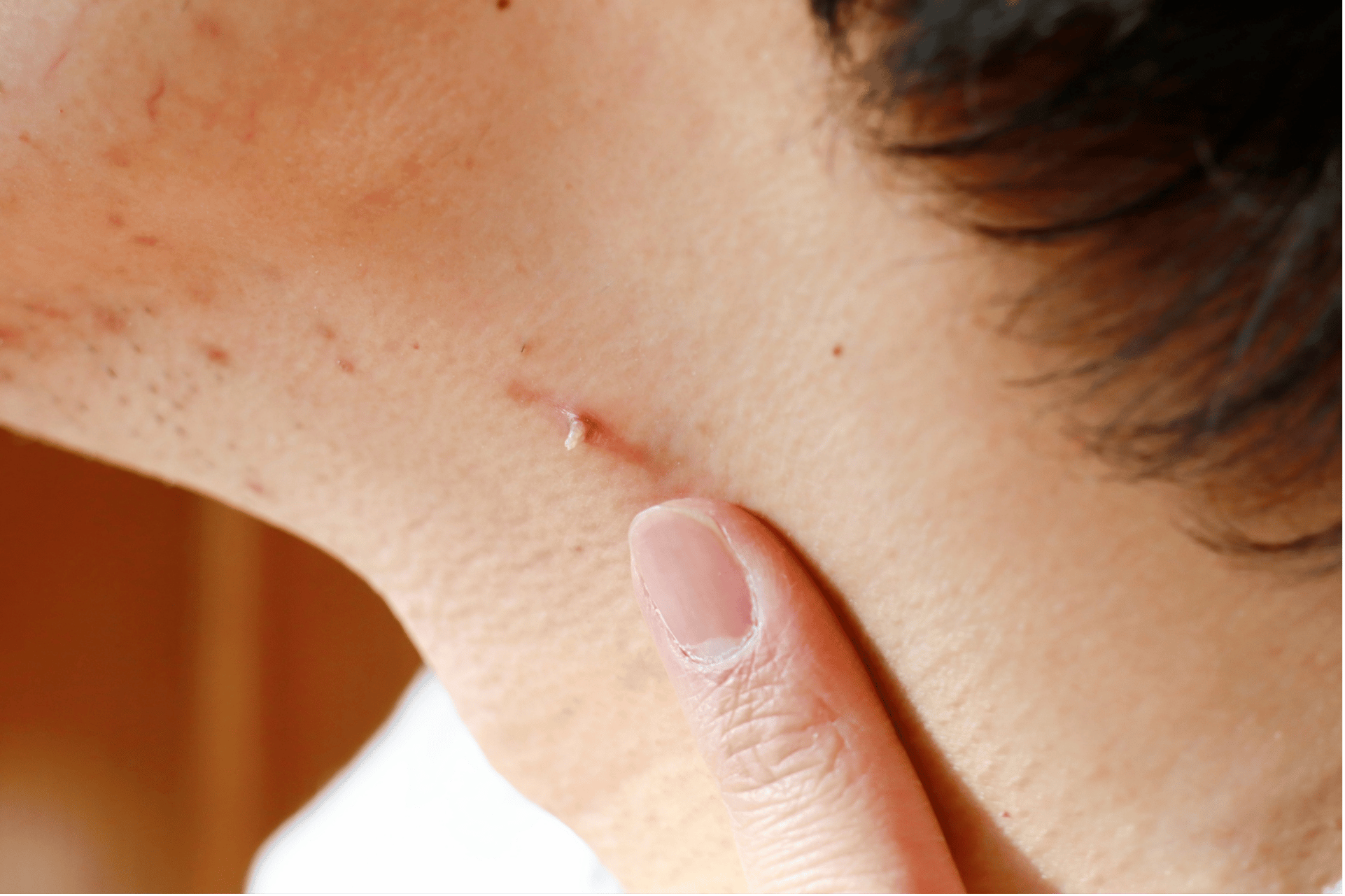 Stielwarzen am Hals oder Achsel