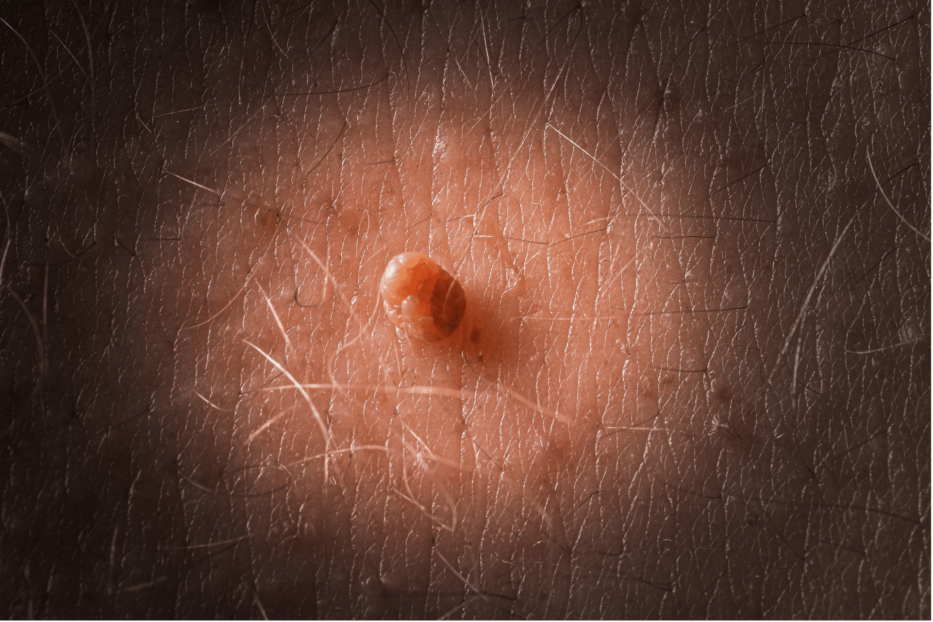 Illustration der Vereisung eines Fibroms