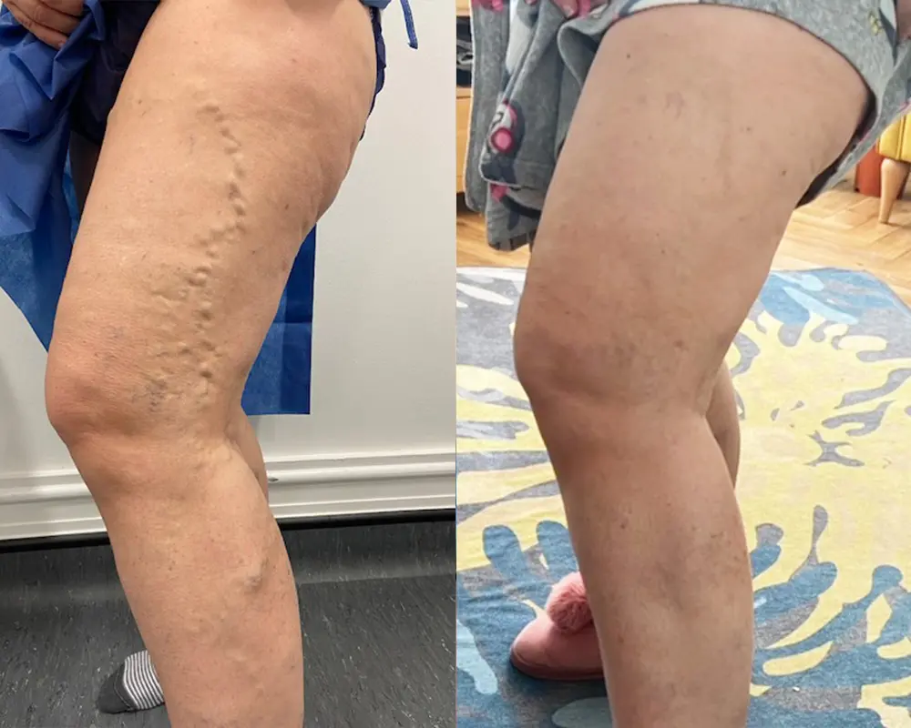 VeinRelief™ Vein Soothing Spray | Eliminates 95% varicose veins and swelling in just 5 days!