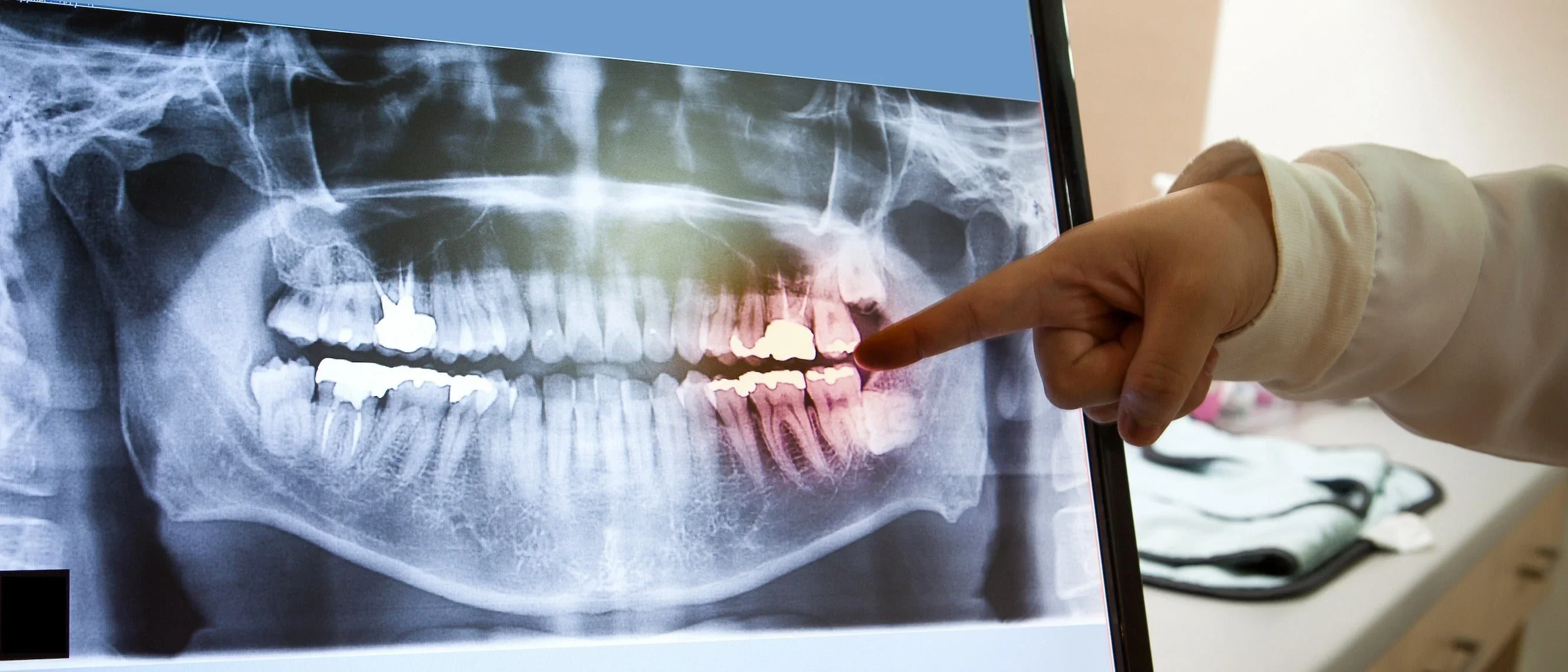 Dental X-Ray