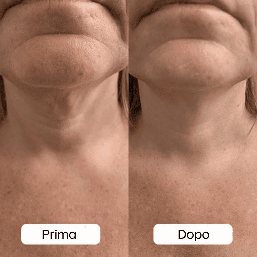 Photo avant-après Chiara