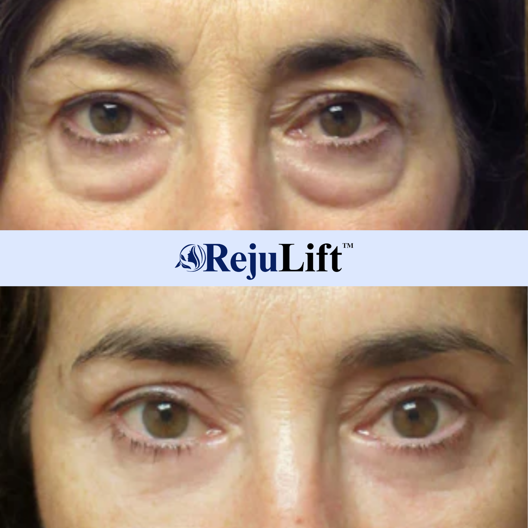 RejuLift™ Lifting Serum | Facelift without Botox 15 RejuLift™ Lifting Serum | Facelift without Botox