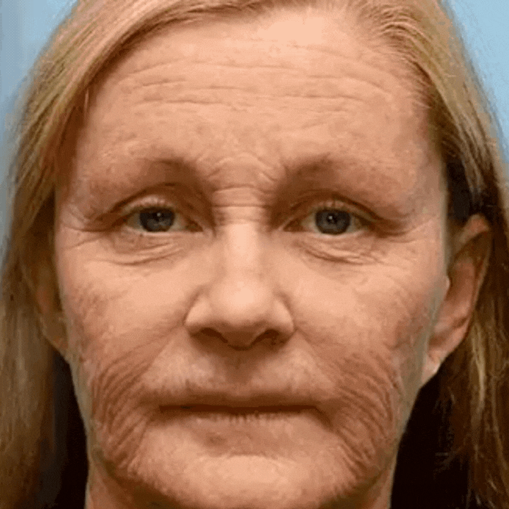 RejuLift™ Lifting Serum | Facelift without Botox 12 RejuLift™ Lifting Serum | Facelift without Botox