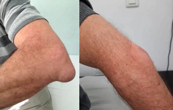 BeeMend™ | Eliminate joint pain and swelling