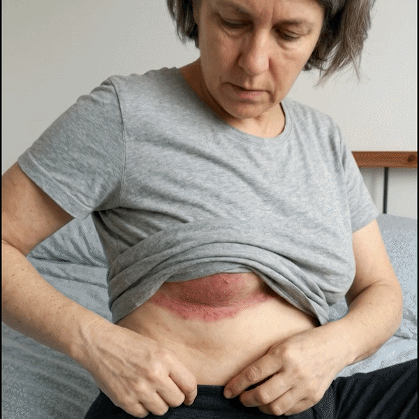 Shelpora Anti-Friction Stick - Skin fold rash relief